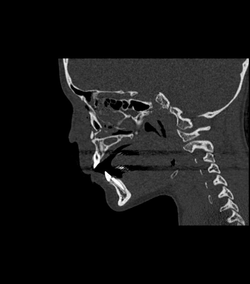 Nasoorbitoethmoid fracture (Radiopaedia 90044-107205 Sagittal bone window 86).jpg