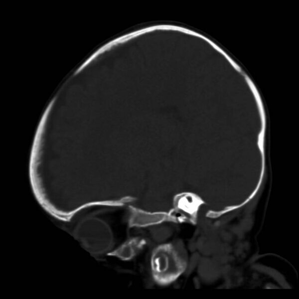 File:Neuroblastoma with skull metastases (Radiopaedia 30326-30958 Sagittal bone window 28).jpg