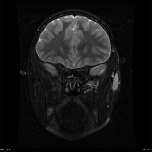 File:Neurofibromatosis type 1 (Radiopaedia 22541-22564 C 14).jpg