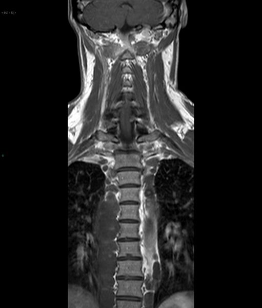 File:Neurofibromatosis type 1 (Radiopaedia 36933-38560 Coronal T1 13).jpg