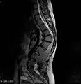 Neurofibromatosis type 2 - cranial and spinal involvement (Radiopaedia 5351-7112 B 9).jpg