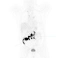 Non-Hodgkin lymphoma involving seminal vesicles with development of interstitial pneumonitis during Rituximab therapy (Radiopaedia 32703-33677 Annotated PET 2).jpg