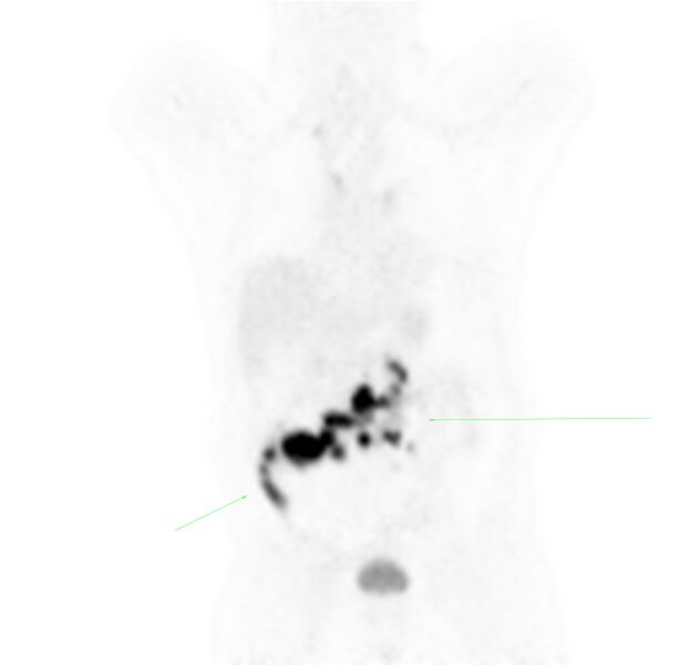File:Non-Hodgkin lymphoma involving seminal vesicles with development of interstitial pneumonitis during Rituximab therapy (Radiopaedia 32703-33677 Annotated PET 2).jpg