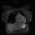 Non-compaction of the left ventricle (Radiopaedia 38868-41062 Coronal SSFP 2D FS 15).jpg