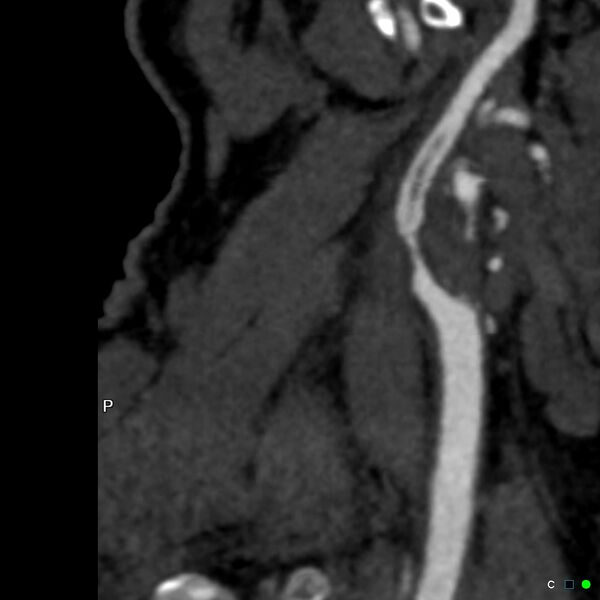 File:Non-occlusive intraluminal internal carotid artery thrombus (Radiopaedia 37751-39658 A 16).jpg