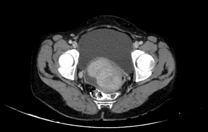 File:Non-puerperal uterine inversion (Radiopaedia 78343-91094 A 53).jpg
