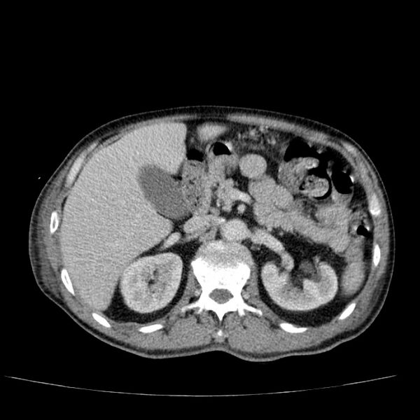 File:Non small-cell lung cancer (Radiopaedia 24467-24769 C+ delayed 67).jpg