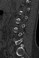 Normal CT lumbar spine (Radiopaedia 53981-60118 Sagittal bone window 69).jpg
