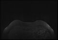 Normal breast MRI - dense breasts (Radiopaedia 80454-93850 Axial T1 6).jpg