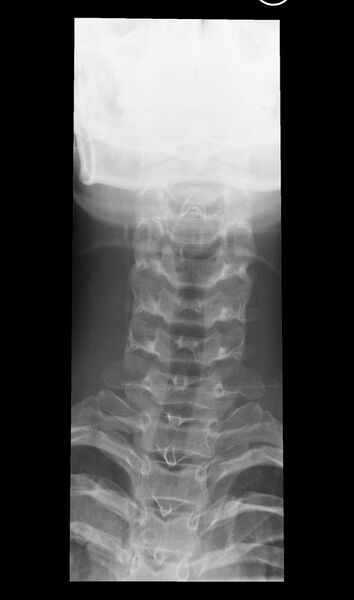File:Normal cervical spine trauma radiographs (age 14) (Radiopaedia 45337-49360 Frontal 1).jpg