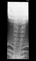 Normal cervical spine trauma radiographs (age 14) (Radiopaedia 45337-49360 Frontal 1).jpg