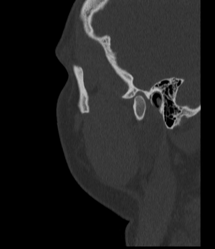 Normal facial bone CT (Radiopaedia 88742-105476 Sagittal bone window 142).jpg