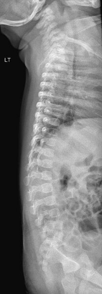 File:Normal lateral whole spine radiograph - infant (Radiopaedia 46694).jpg