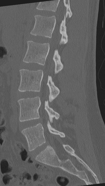File:Normal lumbar spine CT (Radiopaedia 46533-50986 Sagittal bone window 58).png