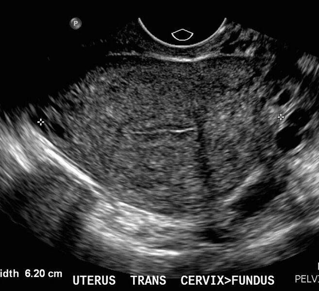 File:Normal proliferative endometrium (Radiopaedia 30417).jpg