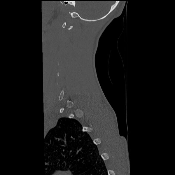 File:Normal trauma spine imaging (age 16) (Radiopaedia 45335-49358 Sagittal bone window 35).jpg