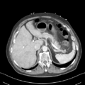 Nutmeg liver (Radiopaedia 49958-55246 A 16).png