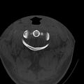 Occipital condyle fracture (Radiopaedia 31755-32691 Axial bone window 16).jpg