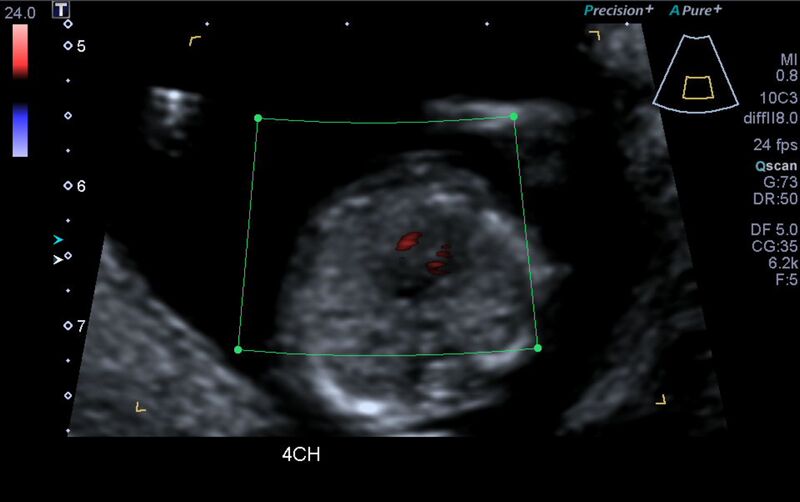 File:1st trimester nuchal-morphology ultrasound (Radiopaedia 44706-48477 Heart views cine with colour 49).jpg