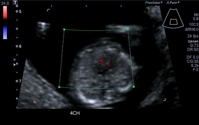 1st trimester nuchal-morphology ultrasound (Radiopaedia 44706-48477 Heart views cine with colour 49).jpg