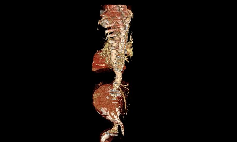 File:Abdominal aortic aneurysm- extremely large, ruptured (Radiopaedia 19882-19921 3D 13).jpg