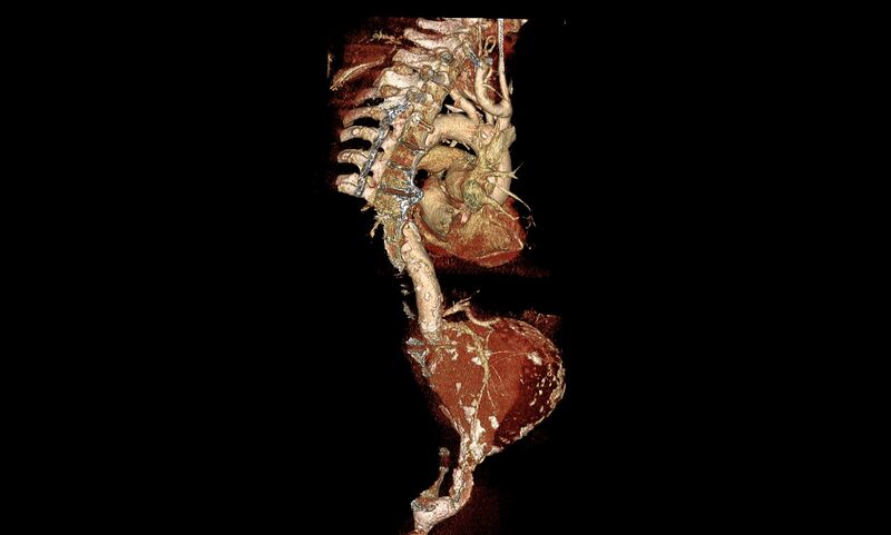 File:Abdominal aortic aneurysm- extremely large, ruptured (Radiopaedia 19882-19921 3D 18).jpg