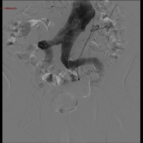 File:Abdominal aortic aneurysm (Radiopaedia 16155-15833 Frontal Aorta 5).jpg