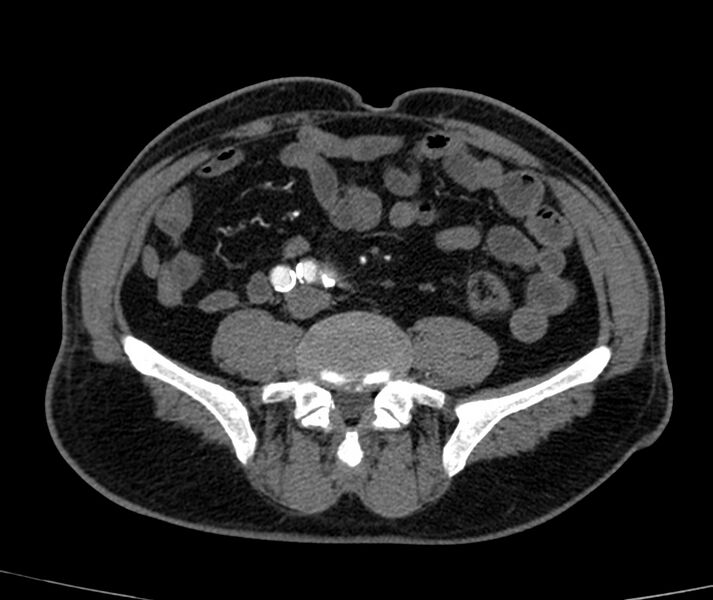 File:Abdominal aortic aneurysm (Radiopaedia 22421-22458 C+ arterial phase 61).jpg