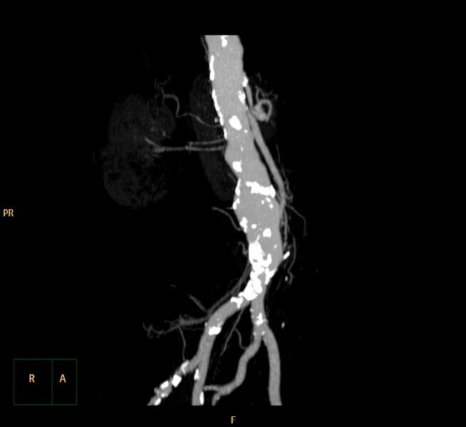 File:Abdominal aortic aneurysm (Radiopaedia 23703-23856 MIP 5).jpg
