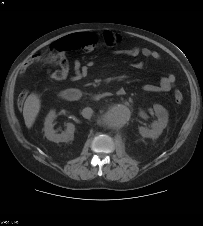 Abdominal aortic aneurysm with intramural hematoma then rupture (Radiopaedia 50278-55631 Axial non-contrast 69).jpg
