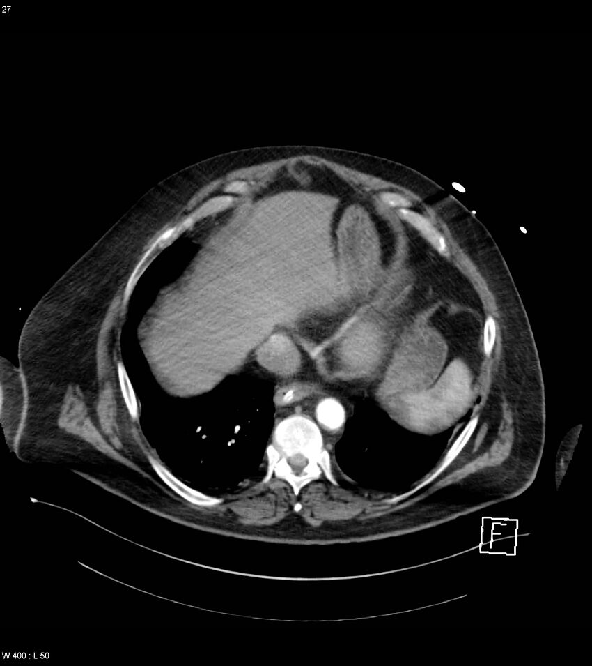 Abdominal aortic aneurysm with intramural hematoma then rupture (Radiopaedia 50278-55632 Axial C+ arterial phase 26).jpg