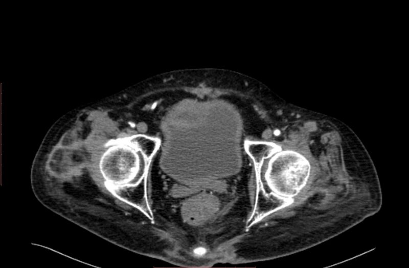 File:Abdominal aortic interposition tube graft and aneurysm thrombosis (Radiopaedia 71438-81857 Axial C+ arterial phase 226).jpg