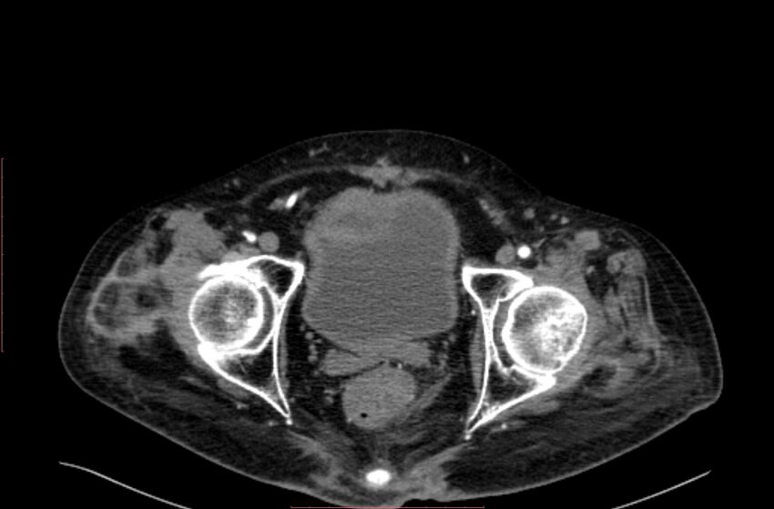 Abdominal aortic interposition tube graft and aneurysm thrombosis (Radiopaedia 71438-81857 Axial C+ arterial phase 226).jpg