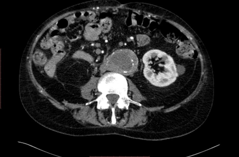 File:Abdominal aortic interposition tube graft and aneurysm thrombosis (Radiopaedia 71438-81857 Axial C+ arterial phase 89).jpg