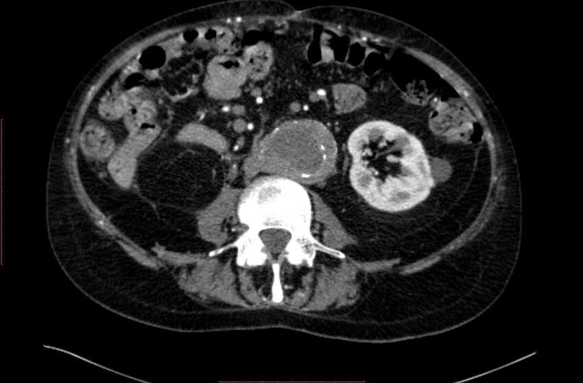 Abdominal aortic interposition tube graft and aneurysm thrombosis (Radiopaedia 71438-81857 Axial C+ arterial phase 89).jpg