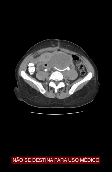File:Abdominal desmoid tumor (Radiopaedia 44024-47540 Axial C+ arterial phase 26).jpg