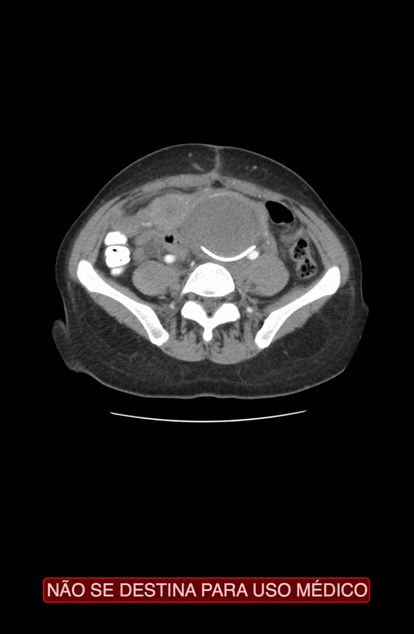 Abdominal desmoid tumor (Radiopaedia 44024-47540 Axial C+ arterial phase 26).jpg