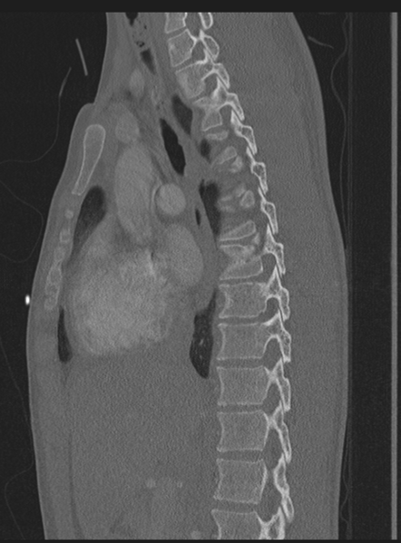 File:Abdominal multi-trauma - devascularised kidney and liver, spleen and pancreatic lacerations (Radiopaedia 34984-36486 Sagittal bone window 41).png