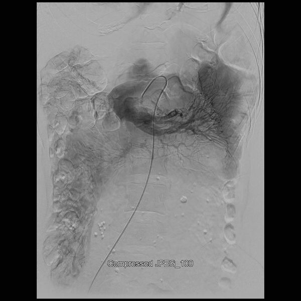 File:Abernethy malformation (Radiopaedia 42006-45462 Frontal Superior mesenteric artery 11).jpg