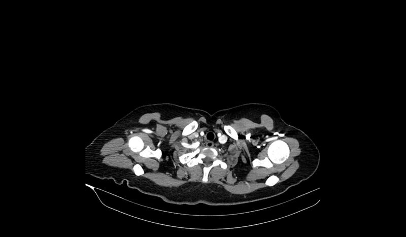 File:Acquired tracheo-esophageal fistula (Radiopaedia 51356-57103 Axial C+ arterial phase 10).jpg