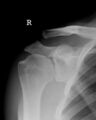 Acromioclavicular joint injury (type II) (Radiopaedia 35958).jpg