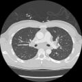 Active right ventricular cardiac sarcoidosis (Radiopaedia 55596-62101 Axial lung window 17).jpg