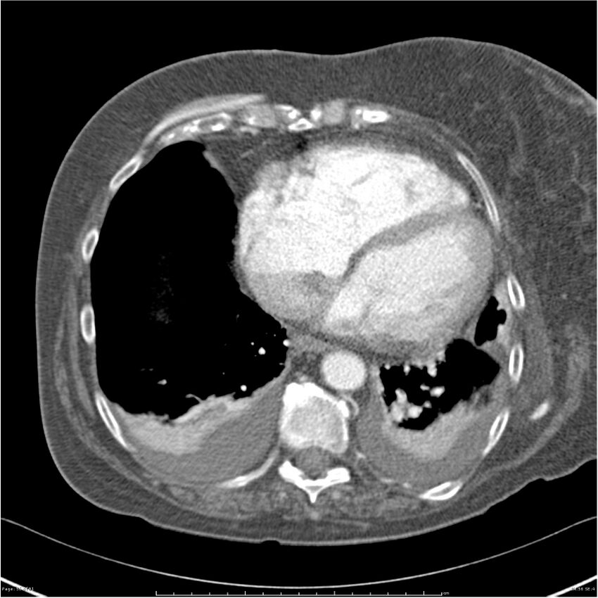 Acute-on-chronic pulmonary emboli (Radiopaedia 27925-28169 C+ CTPA 56).jpg
