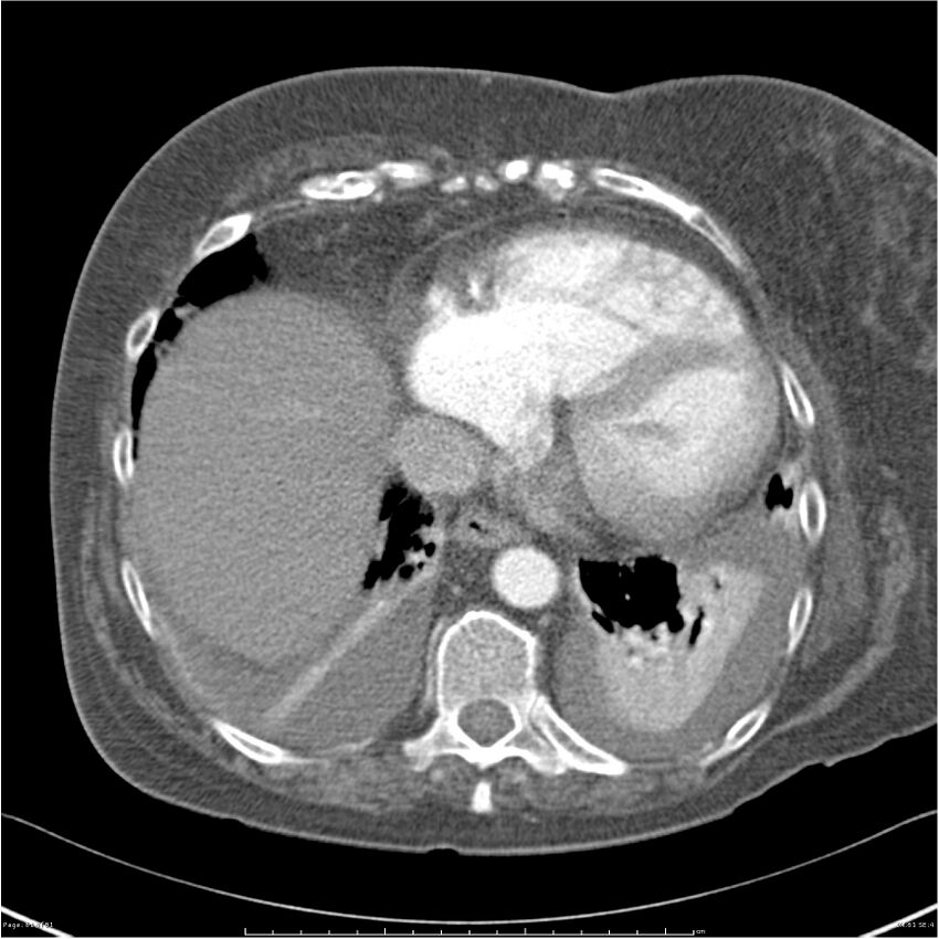 Acute-on-chronic pulmonary emboli (Radiopaedia 27925-28169 C+ CTPA 61).jpg