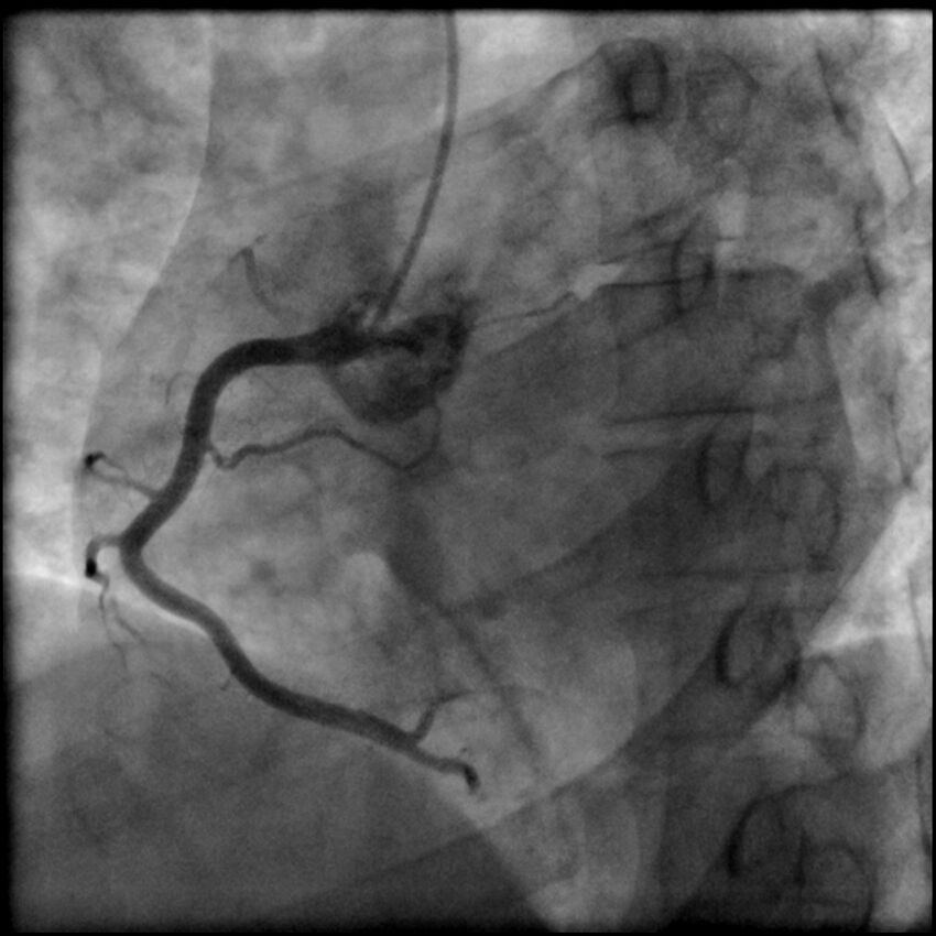 Acute anteroseptal myocardial infarction (Radiopaedia 68409-77946 RAO straight RCA 18).jpg