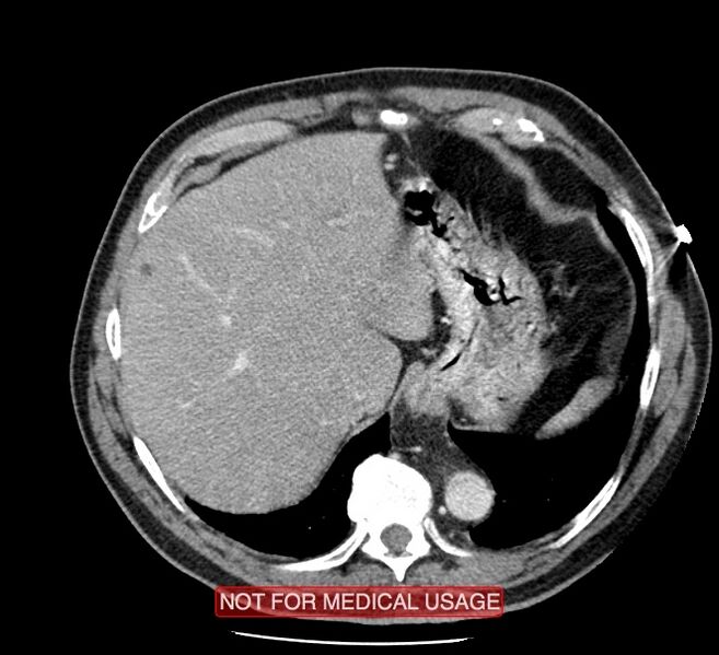 File:Acute aortic dissection - Stanford type A (Radiopaedia 40661-43285 Axial C+ portal venous phase 58).jpg