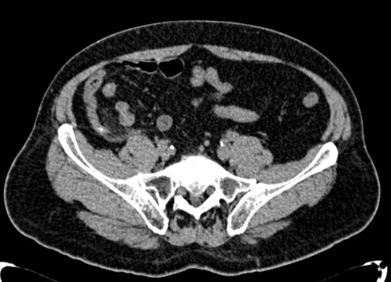 File:Acute appendicitis (Radiopaedia 13030-13091 Axial non-contrast 31).jpg