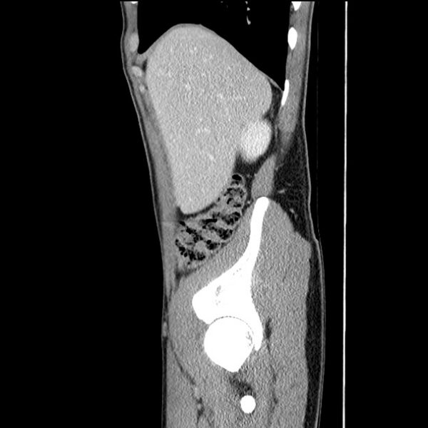 File:Acute appendicitis (Radiopaedia 27049-27227 Sagittal C+ portal venous phase 15).jpg