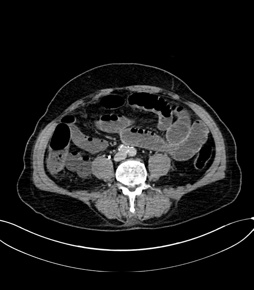Acute arterial mesenteric ischemia (Radiopaedia 78238-90828 Axial C+ delayed 87).jpg