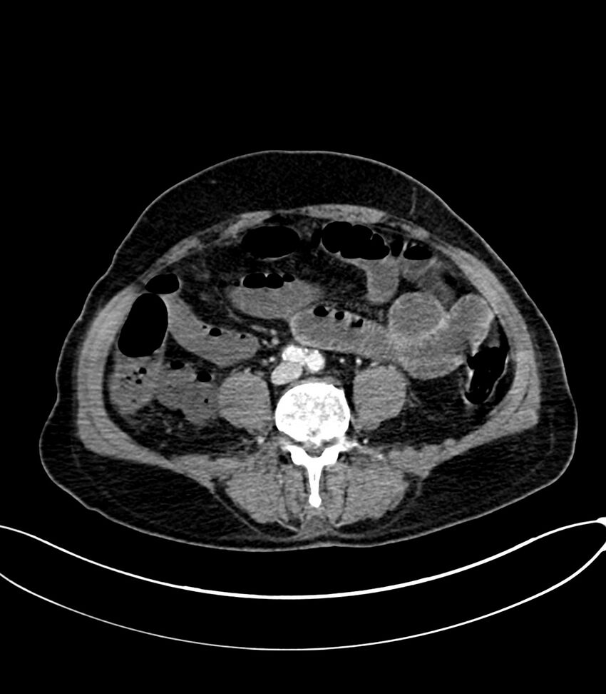 Acute arterial mesenteric ischemia (Radiopaedia 78238-90828 Axial C+ portal venous phase 86).jpg